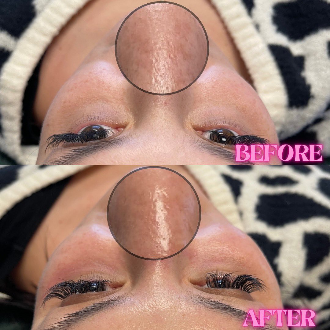 Hydrafacial Before & After Gallery - Patient 146737552 - Image 1