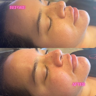 Hydrafacial Before & After Gallery - Patient 146737553 - Image 1