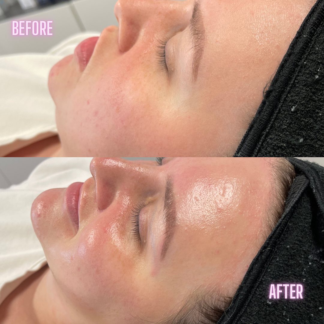 Hydrafacial Before & After Gallery - Patient 146737554 - Image 1