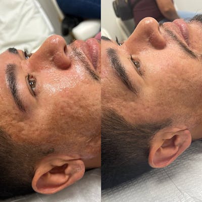 SkinPen Before & After Gallery - Patient 146737560 - Image 1