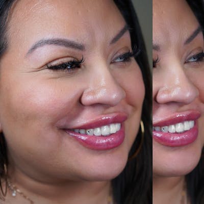 Lip Fillers Before & After Gallery - Patient 146737580 - Image 1