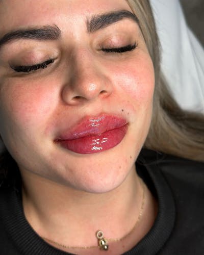 Lip Injection Before & After Gallery - Patient 146737581 - Image 1