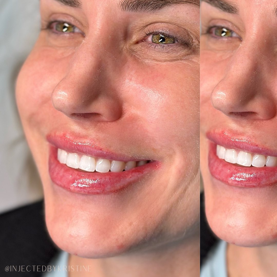 Lip Fillers Before & After Gallery - Patient 146737593 - Image 1