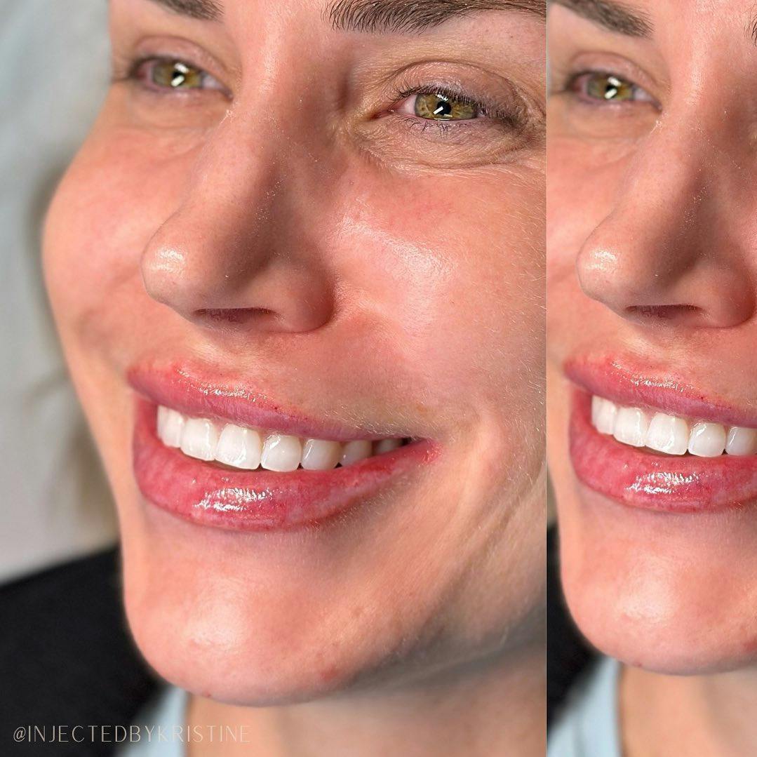 Lip Fillers Before & After Gallery - Patient 146737593 - Image 1