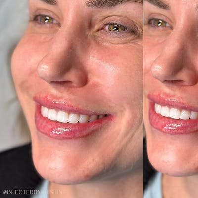Lip Fillers Before & After Gallery - Patient 146737593 - Image 1