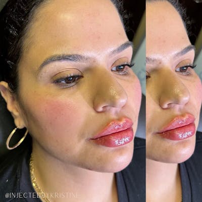 Lip Fillers Before & After Gallery - Patient 146737594 - Image 1