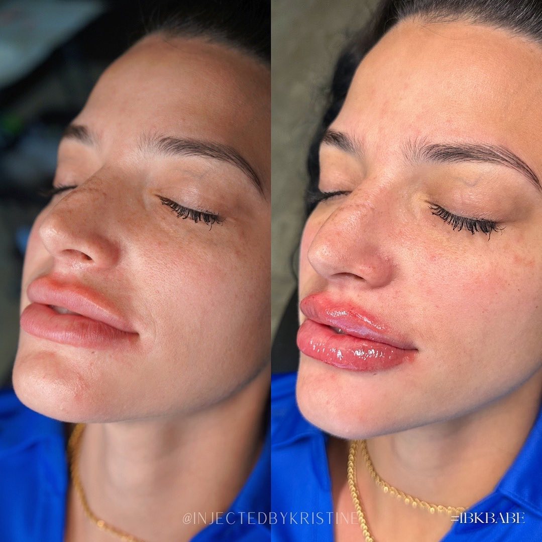 Lip Injection Before & After Gallery - Patient 146737618 - Image 1