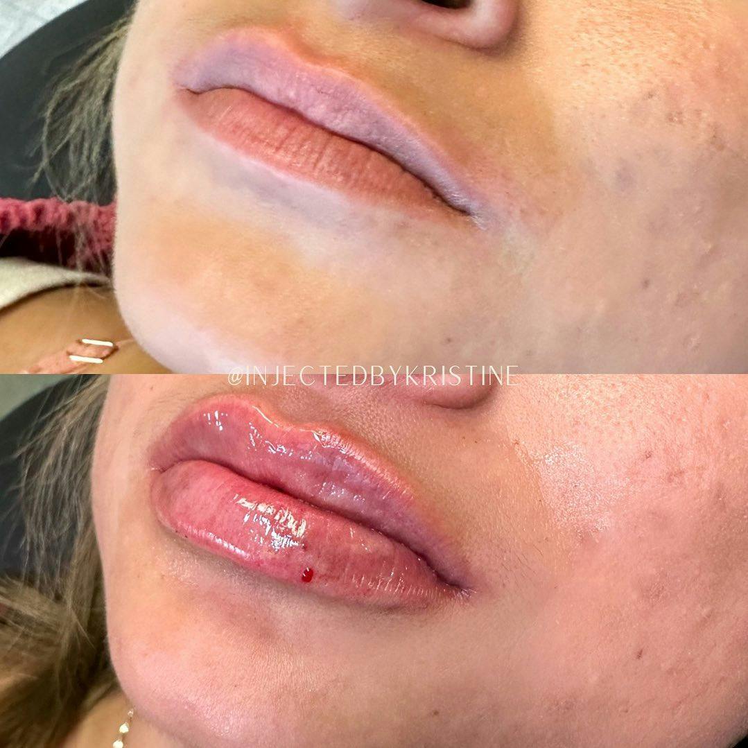 RHA Fillers Before & After Gallery - Patient 146737621 - Image 1