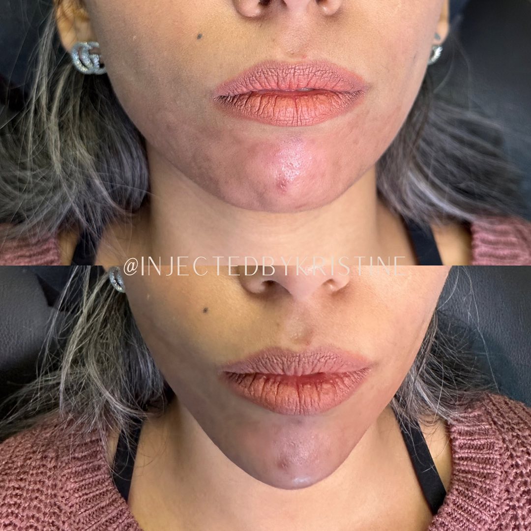 Chin Before & After Gallery - Patient 146737632 - Image 3