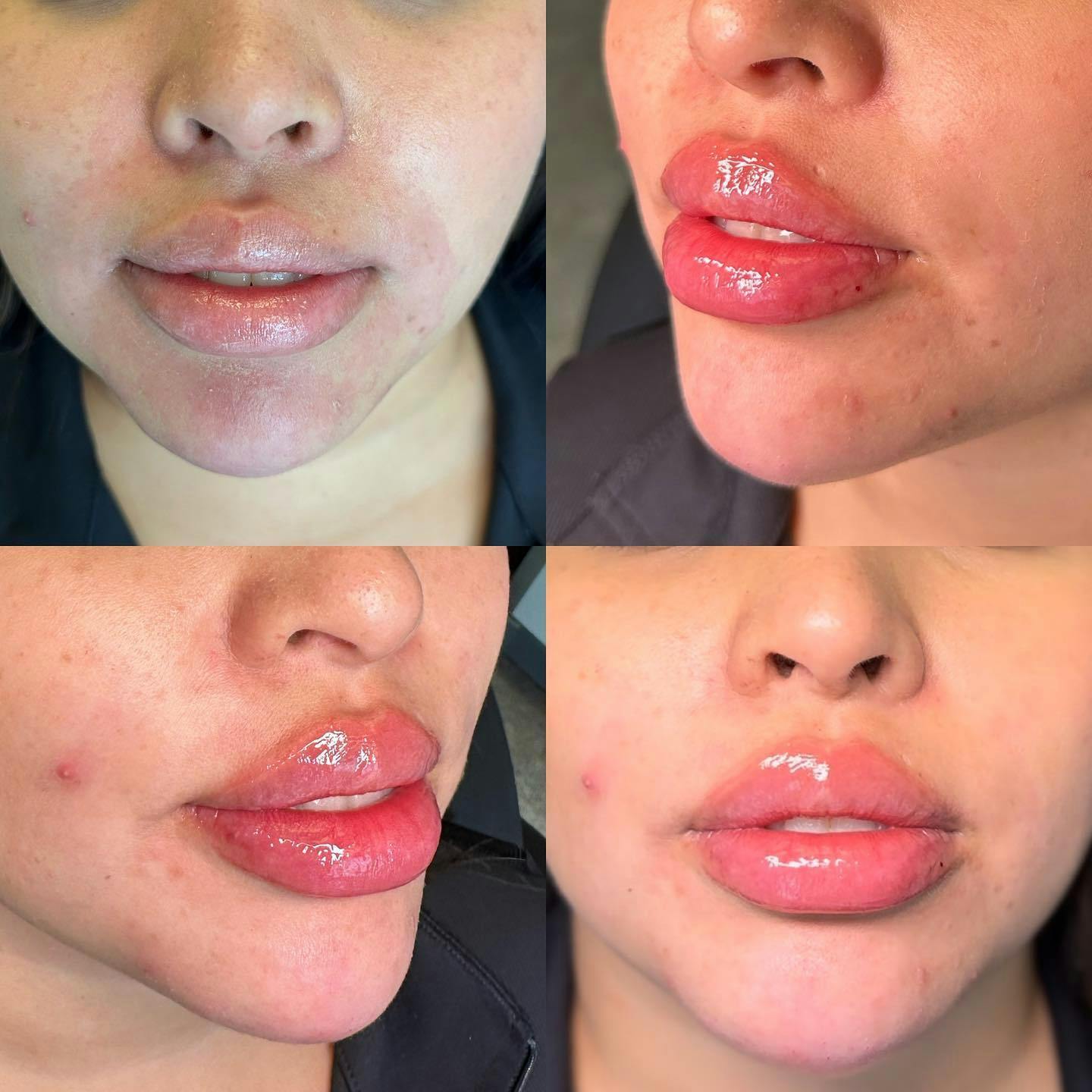 Lip Fillers Before & After Gallery - Patient 146737646 - Image 1