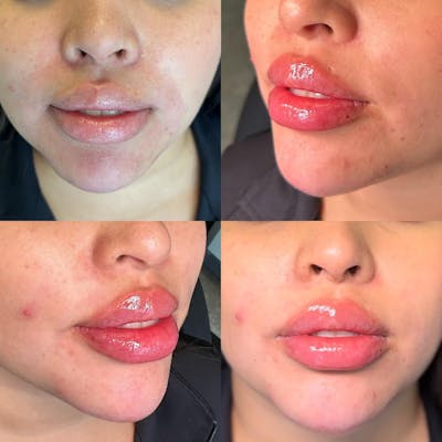 Lip Fillers Before & After Gallery - Patient 146737646 - Image 1
