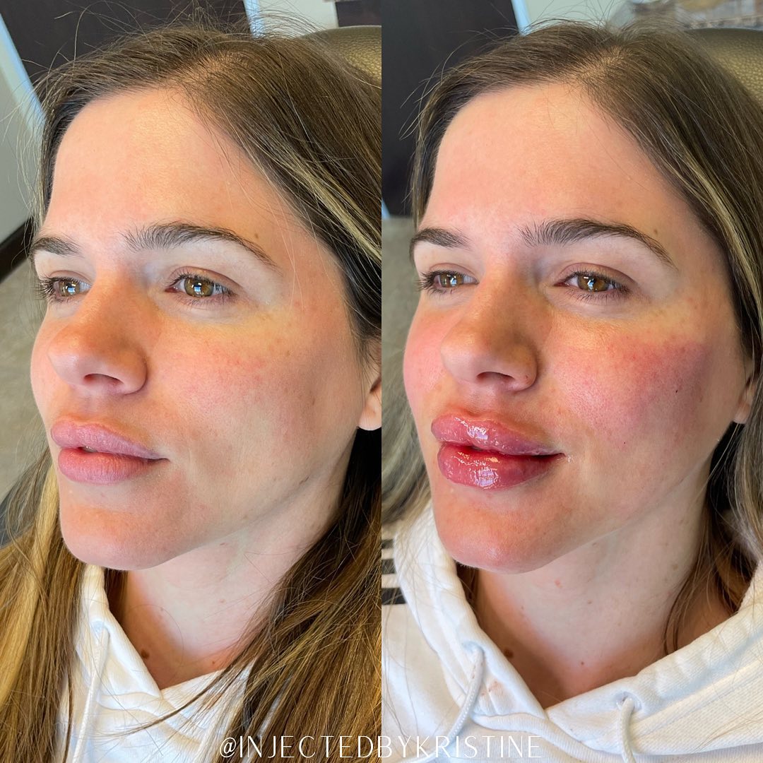 Lip Injection Before & After Gallery - Patient 146737649 - Image 1