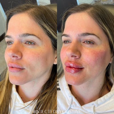 Lip Fillers Before & After Gallery - Patient 146737649 - Image 1