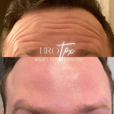 BOTOX Before & After Gallery - Patient 146737651 - Image 1