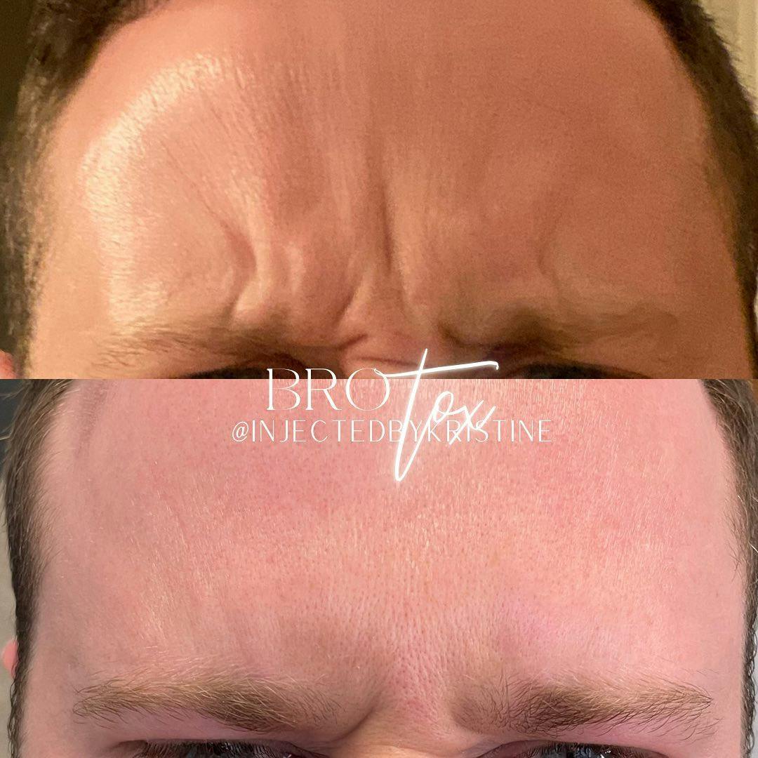 BOTOX Before & After Gallery - Patient 146737651 - Image 2