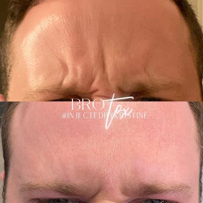 BOTOX Before & After Gallery - Patient 146737651 - Image 2