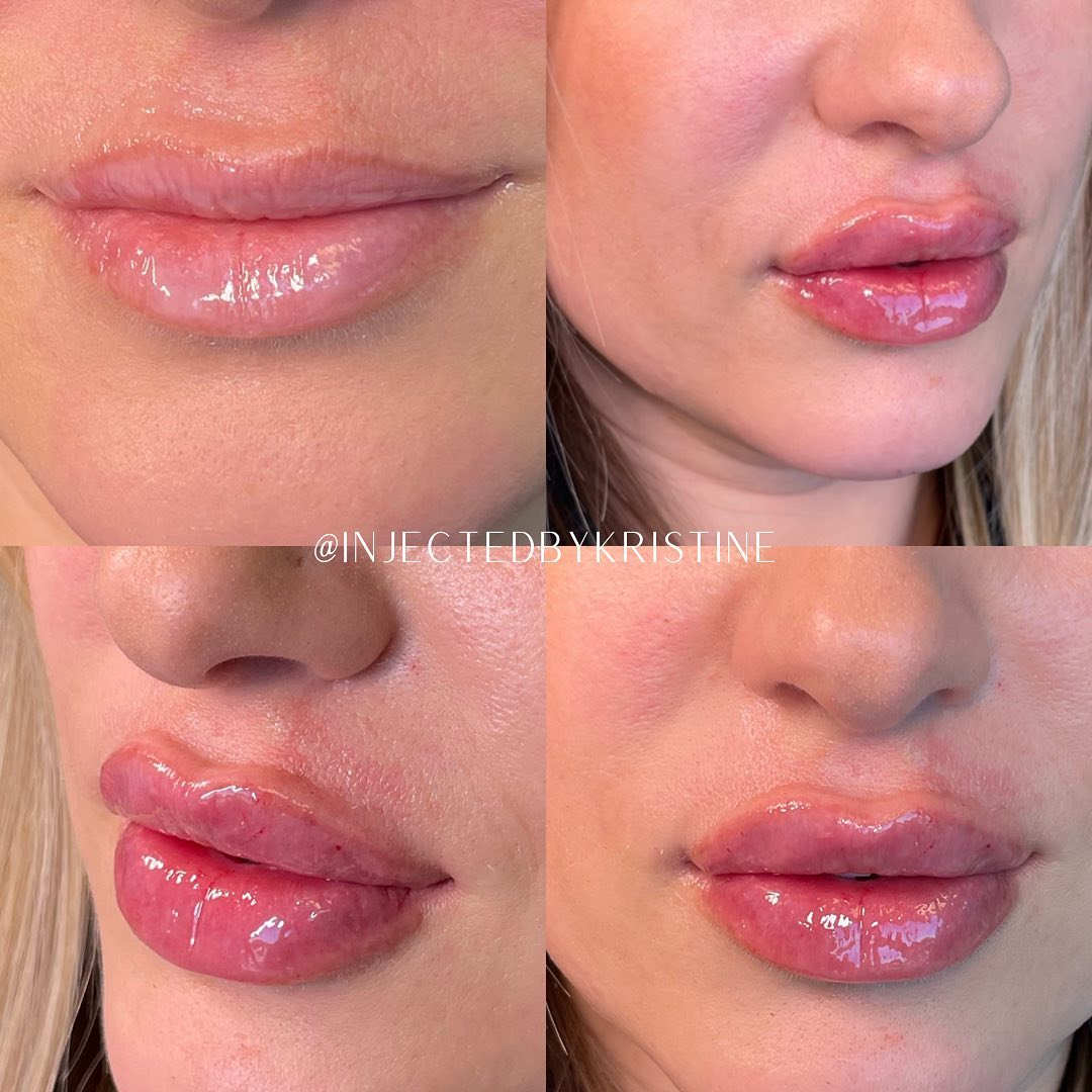 Lip Fillers Before & After Gallery - Patient 146737655 - Image 1