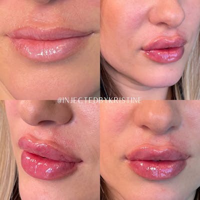 Lip Fillers Before & After Gallery - Patient 146737655 - Image 1