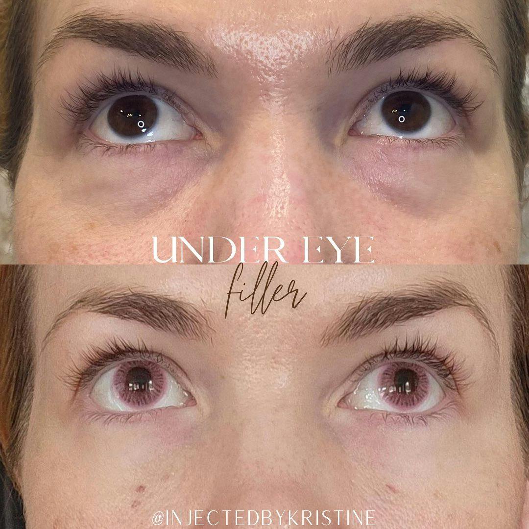 Under-Eye Filler Before & After Gallery - Patient 146737658 - Image 1