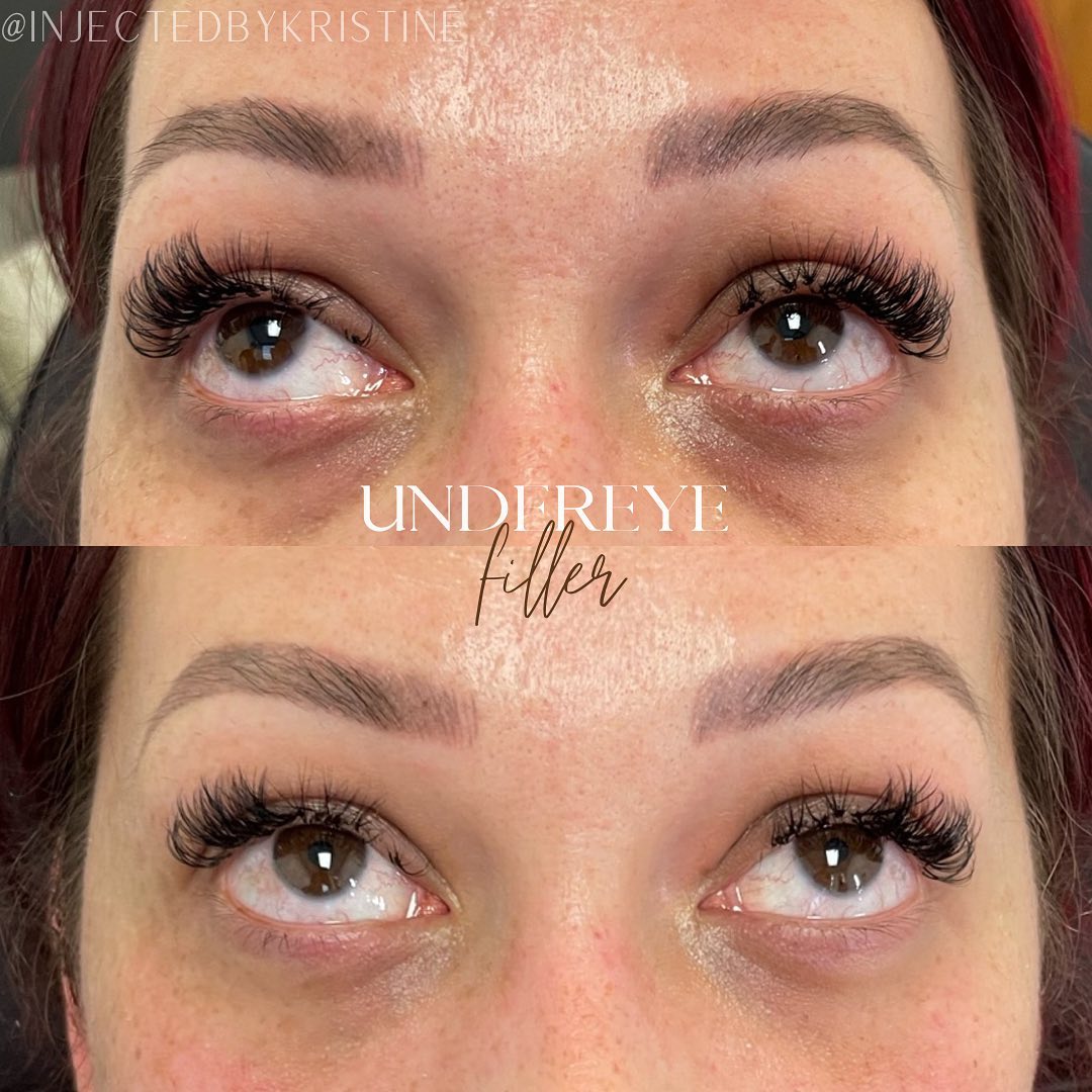 Under-Eye Filler Before & After Gallery - Patient 146737667 - Image 1
