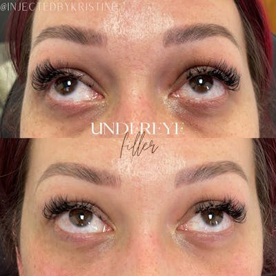 Under-Eye Filler Before & After Gallery - Patient 146737667 - Image 1