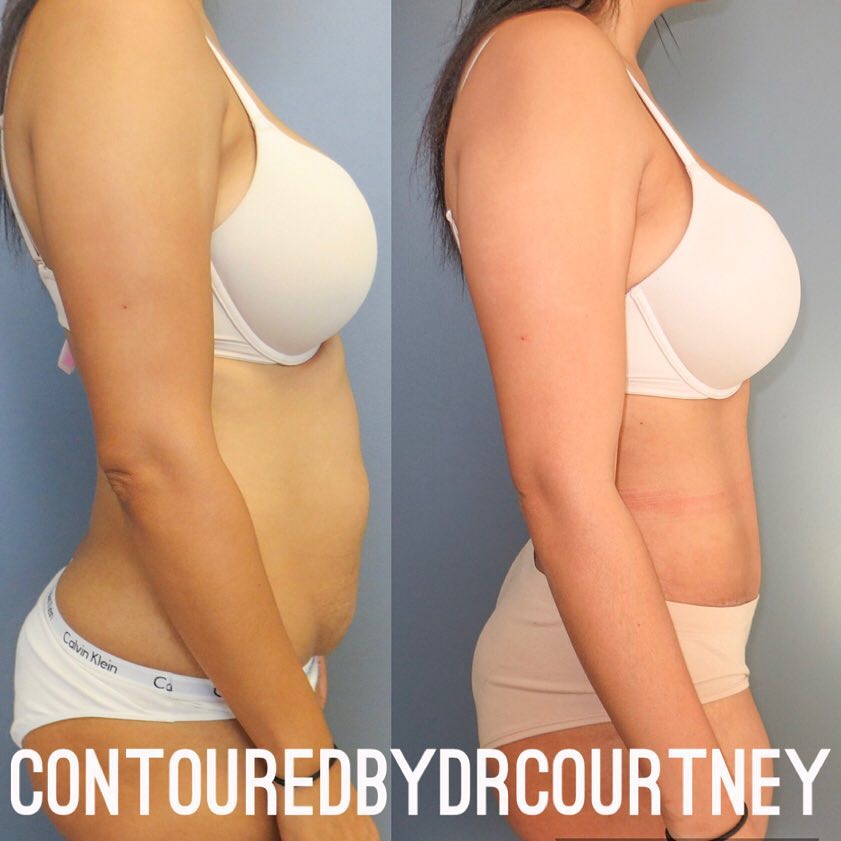 Tummy Tuck (Abdominoplasty)  Before & After Gallery - Patient 146737674 - Image 2