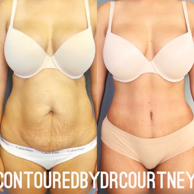 Tummy Tuck (Abdominoplasty)  Before & After Gallery - Patient 146737674 - Image 1