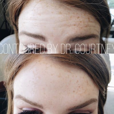 BOTOX Before & After Gallery - Patient 146737676 - Image 1