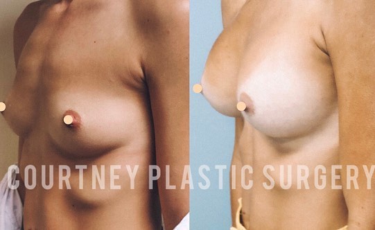 Breast Augmentation Before & After Gallery - Patient 146737690 - Image 2