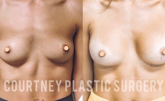 Breast Augmentation Before & After Gallery - Patient 146737690 - Image 1
