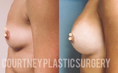 Breast Augmentation Before & After Gallery - Patient 146737690 - Image 3