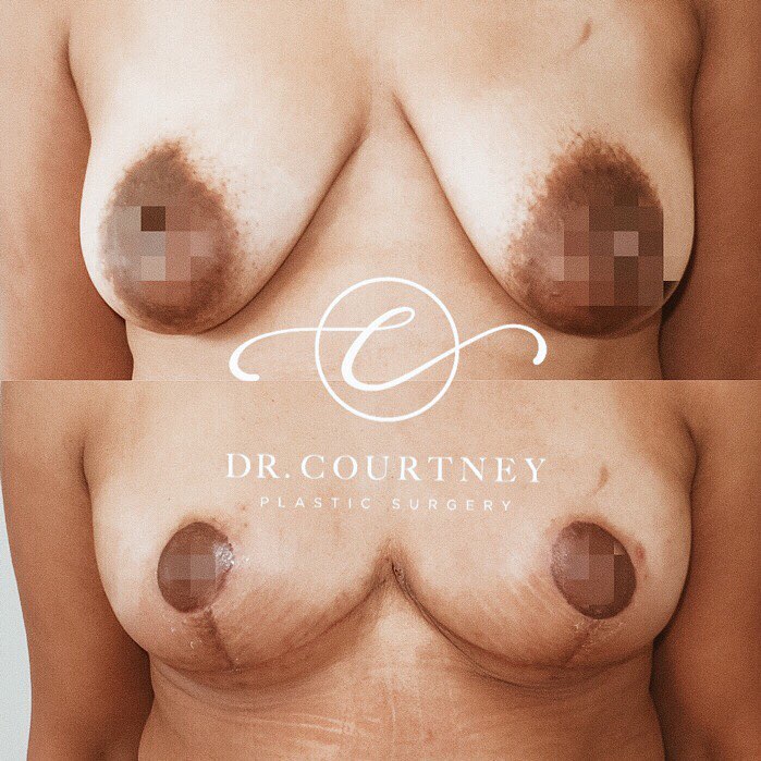 Breast Lift Before & After Gallery - Patient 146737692 - Image 1