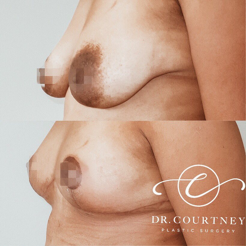 Breast Lift Before & After Gallery - Patient 146737692 - Image 2