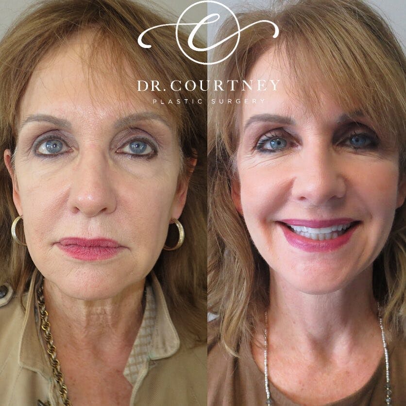 Facelift Before & After Gallery - Patient 146737705 - Image 1