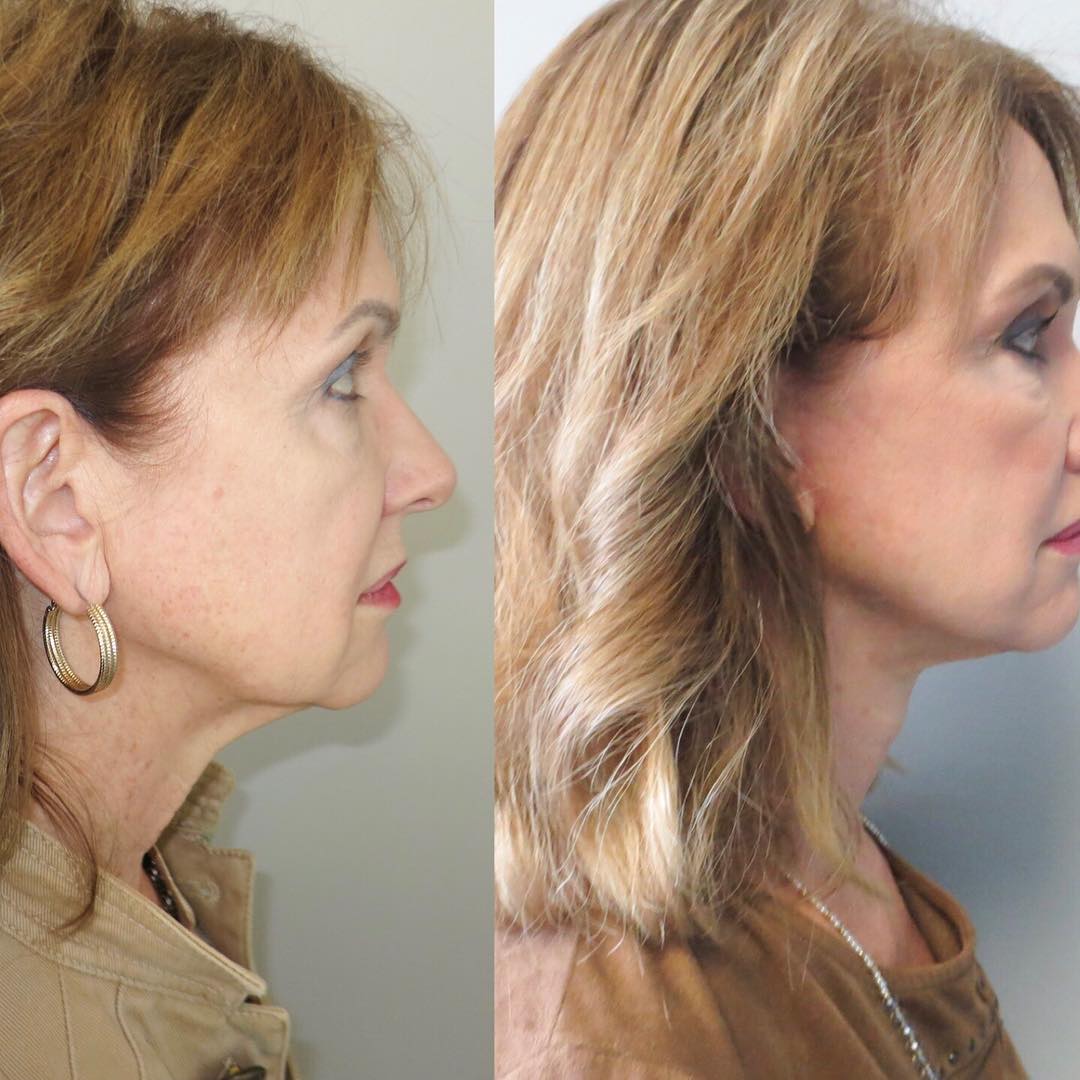 Facelift Before & After Gallery - Patient 146737705 - Image 2