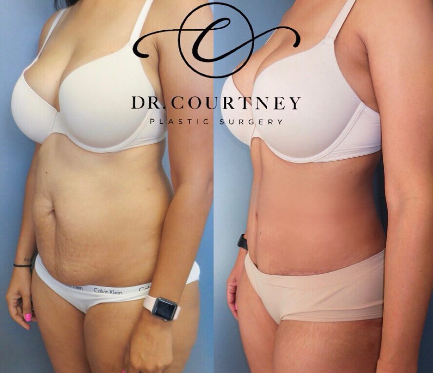 Patient 146737674 | Tummy Tuck (Abdominoplasty) Before & After Photos | Dr.  Courtney Plastic Surgery