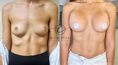Breast Augmentation Before & After Gallery - Patient 146737754 - Image 1