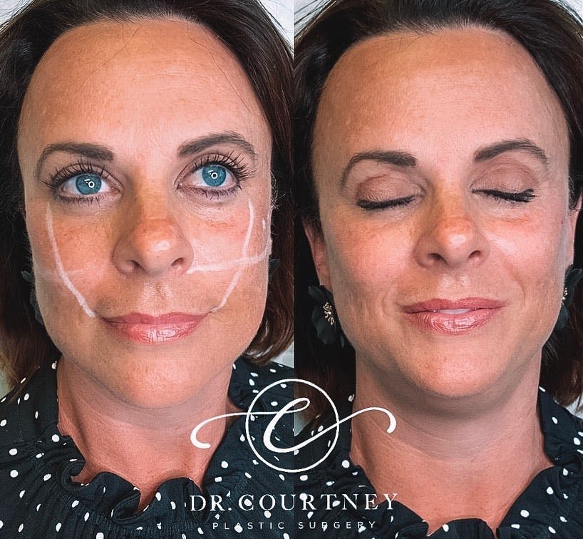 Non-Surgical Facelift Before & After Gallery - Patient 146737786 - Image 1