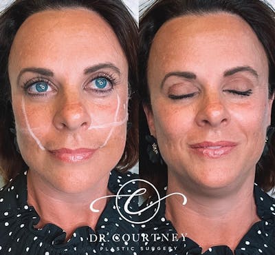 Non-Surgical Facelift Before & After Gallery - Patient 146737786 - Image 1
