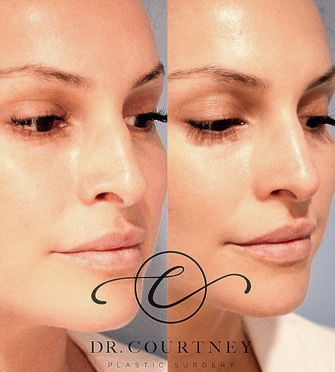 Non-Surgical Rhinoplasty Before & After Gallery - Patient 146737860 - Image 1