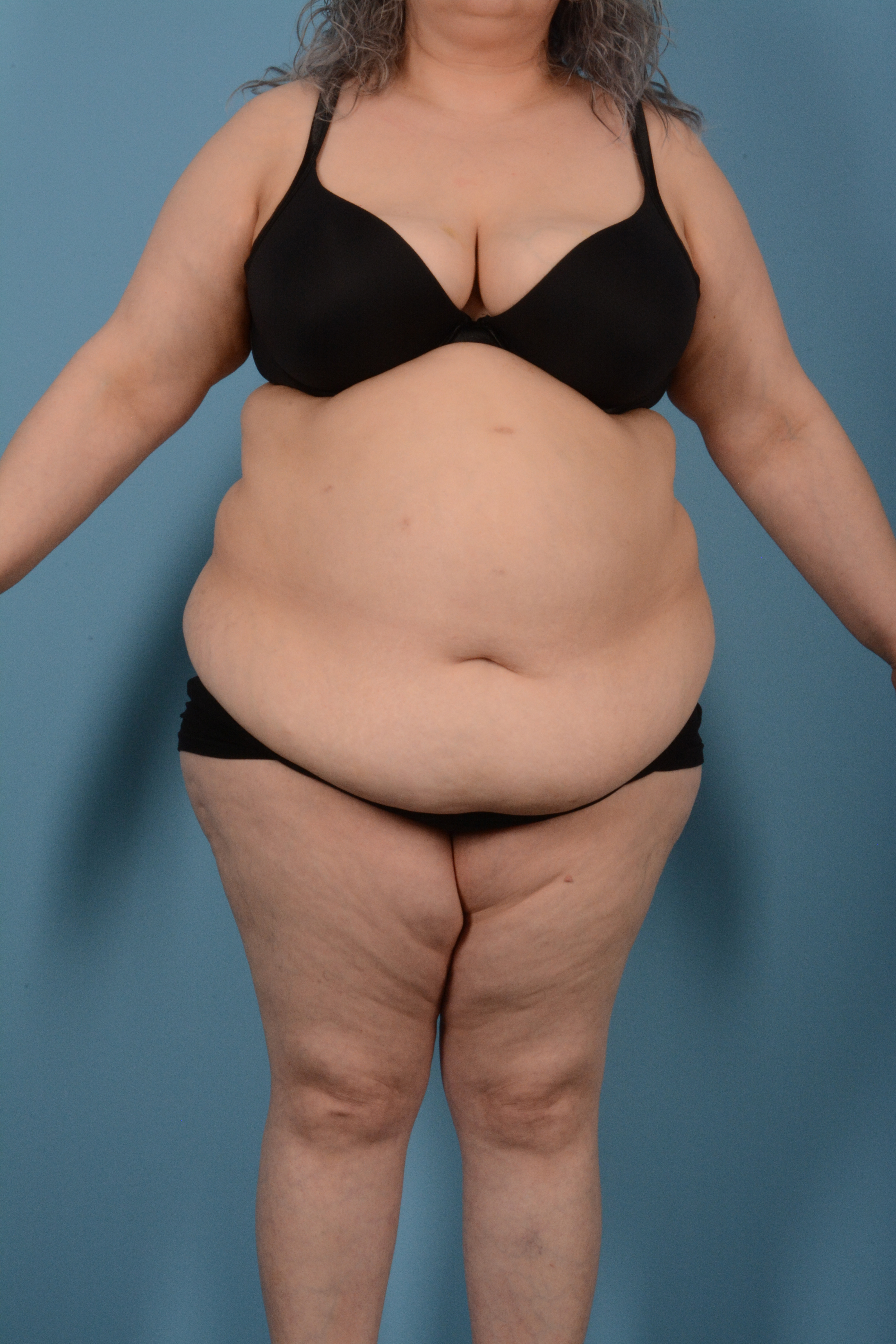 Tummy Tuck (Abdominoplasty)  Before & After Gallery - Patient 146779725 - Image 1