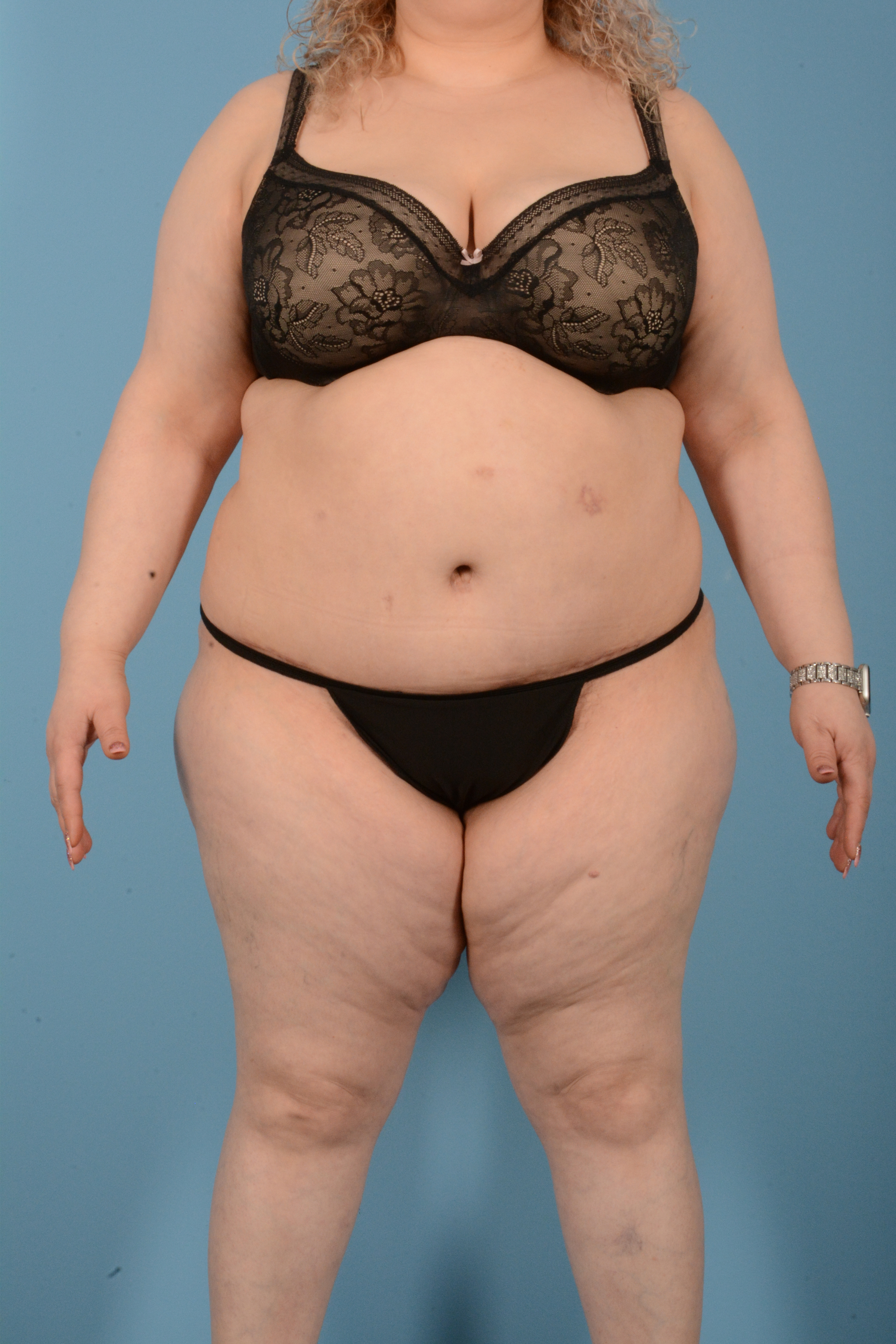 Tummy Tuck (Abdominoplasty)  Before & After Gallery - Patient 146779725 - Image 2