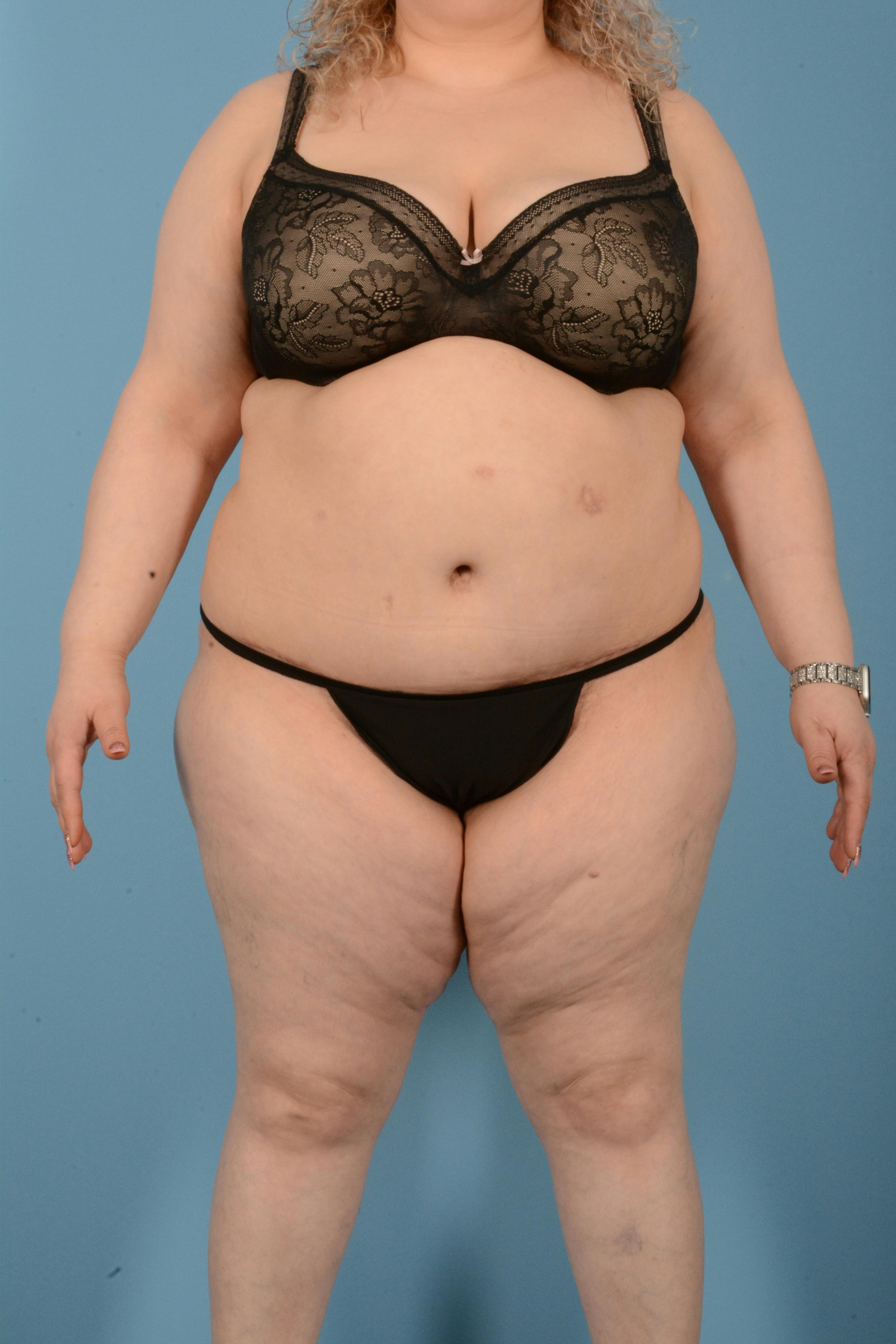 Tummy Tuck (Abdominoplasty)  Before & After Gallery - Patient 146779725 - Image 2