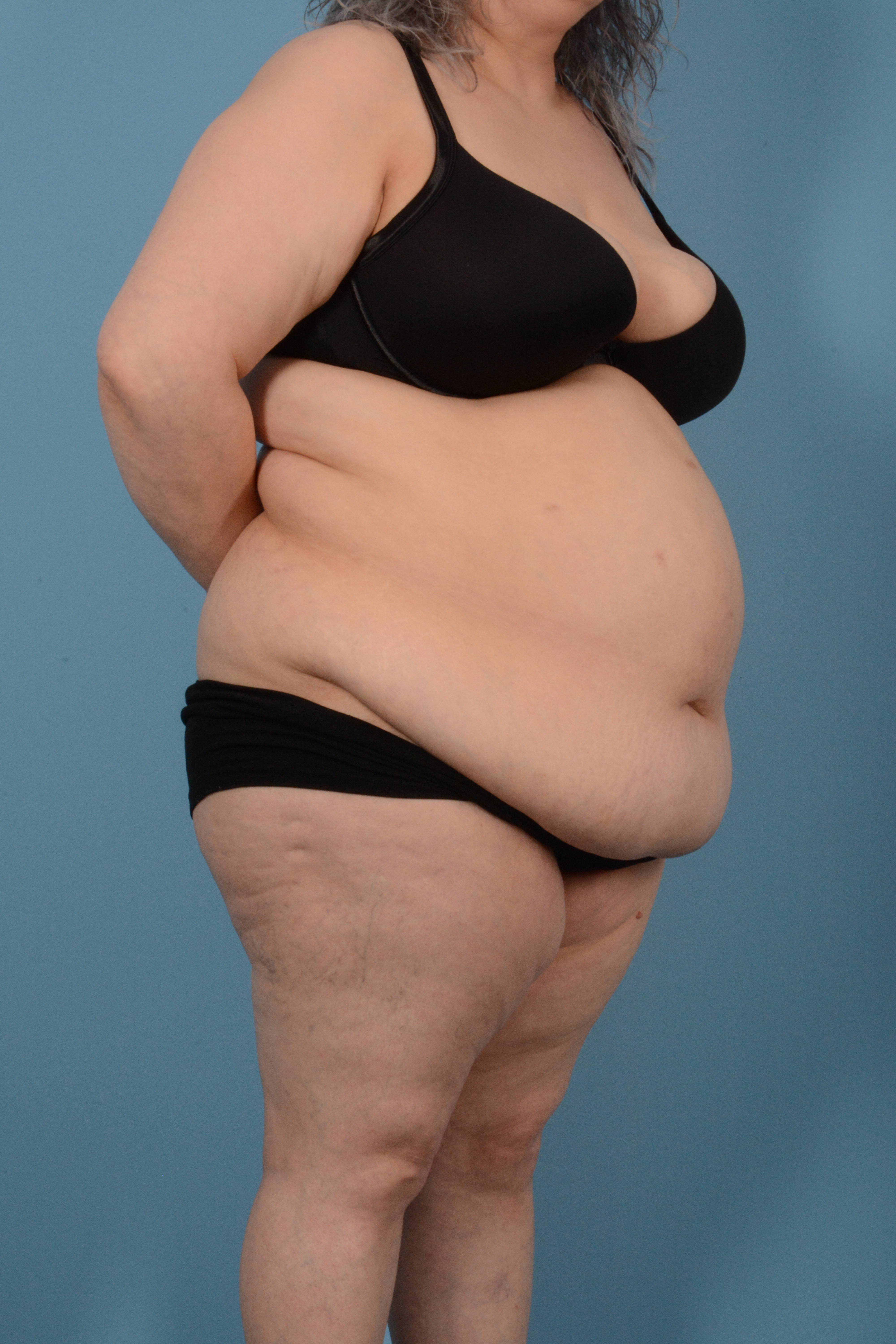 Tummy Tuck (Abdominoplasty)  Before & After Gallery - Patient 146779725 - Image 3