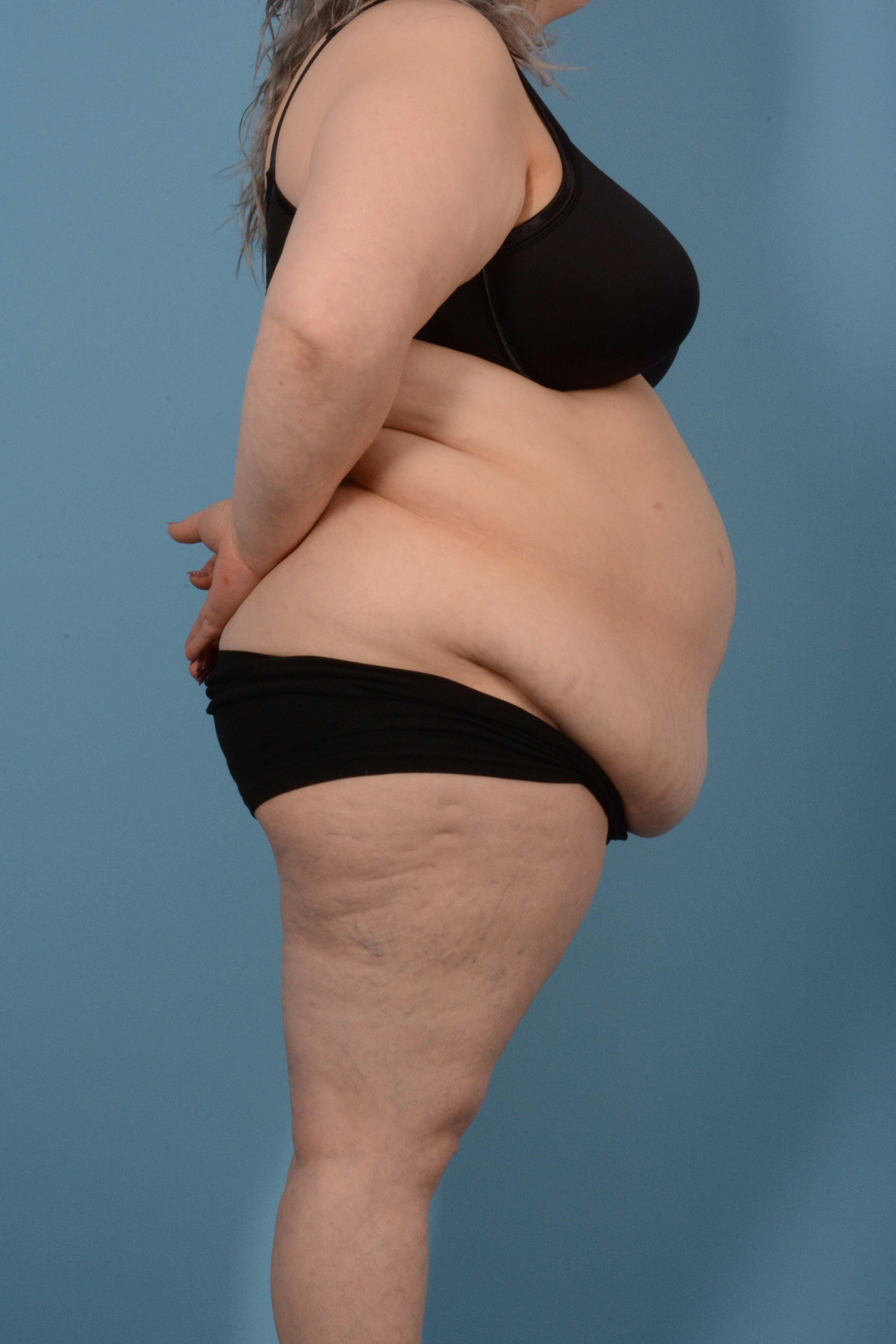 Tummy Tuck (Abdominoplasty)  Before & After Gallery - Patient 146779725 - Image 5