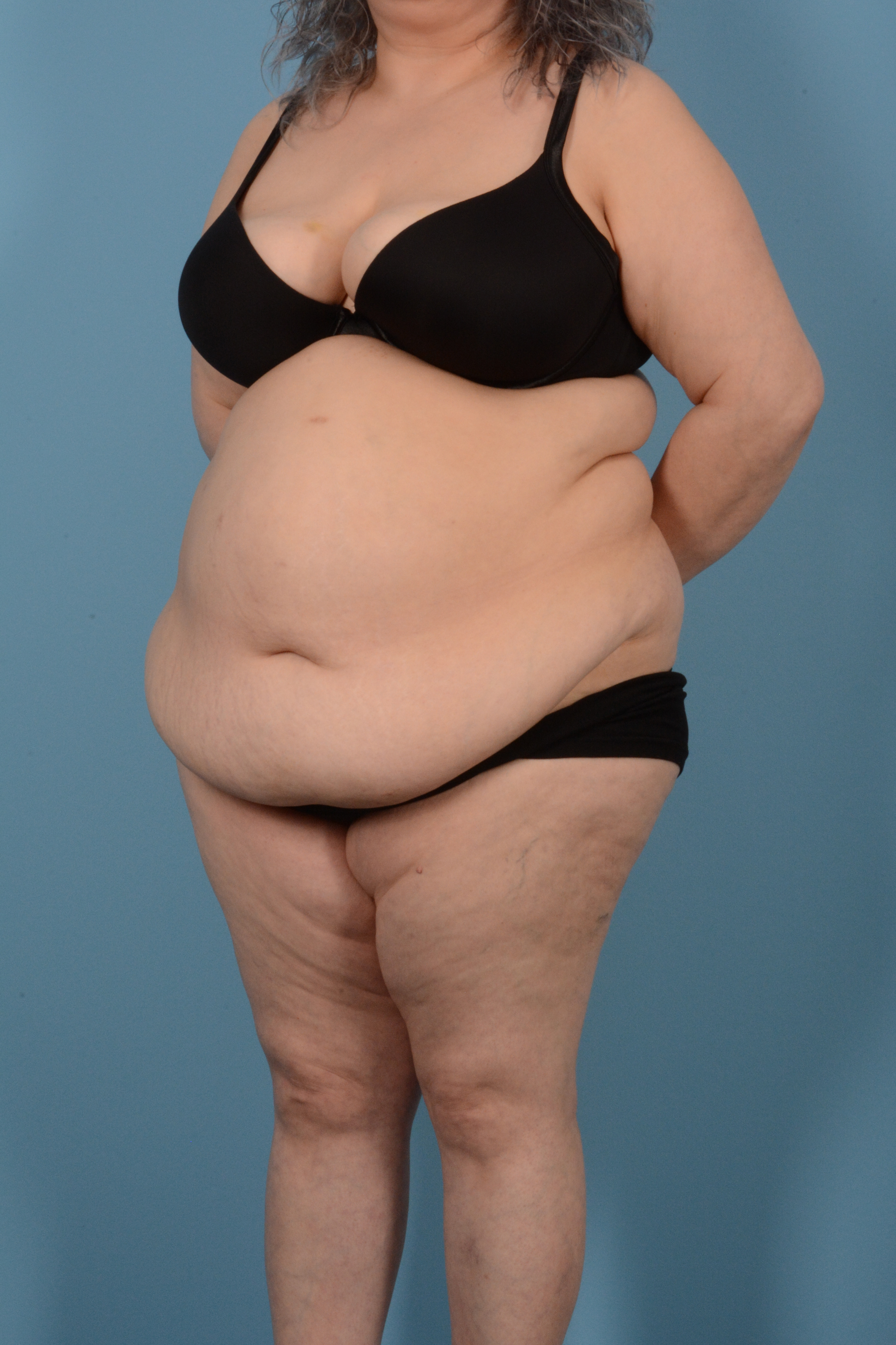 Tummy Tuck (Abdominoplasty)  Before & After Gallery - Patient 146779725 - Image 7