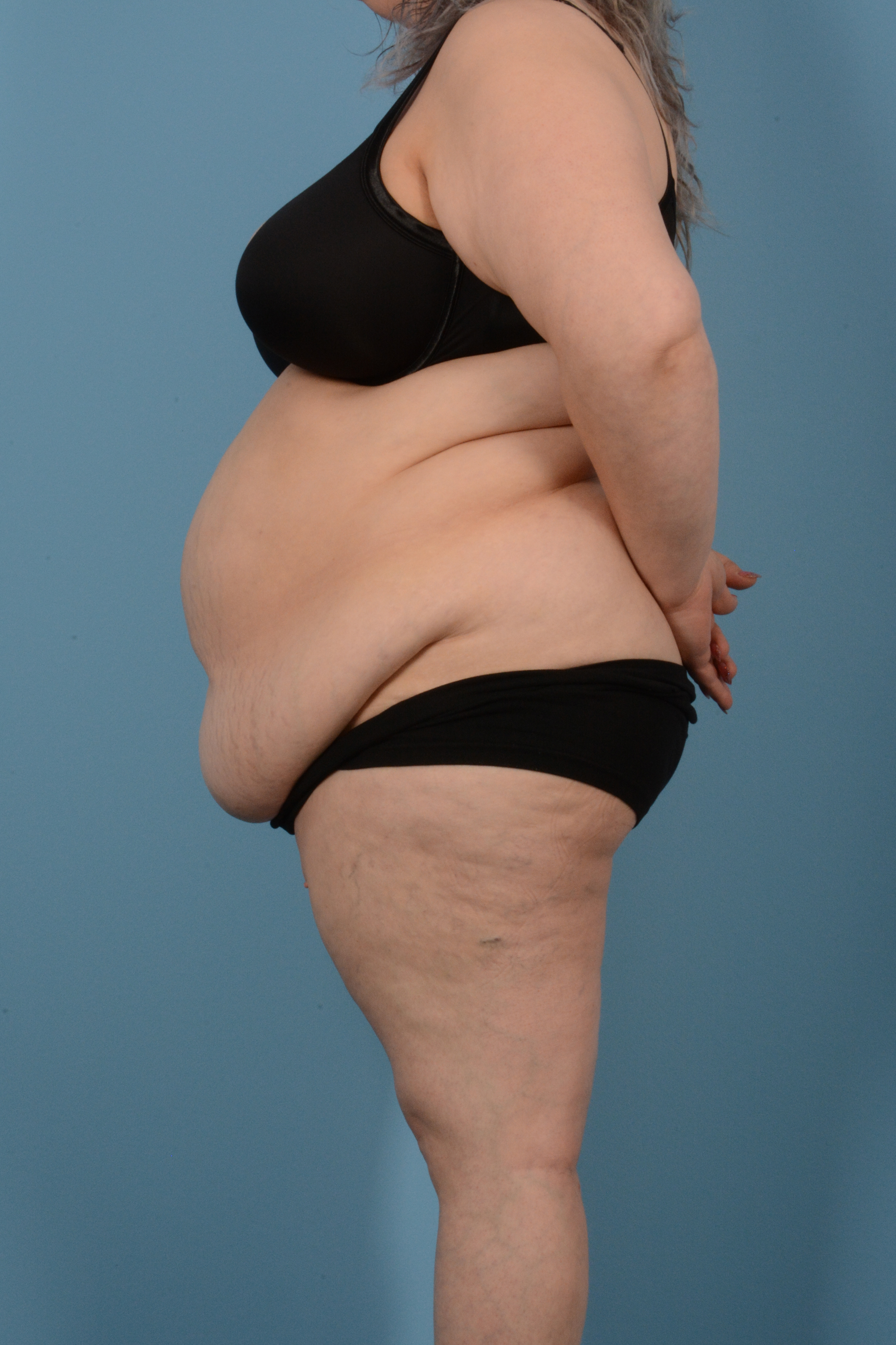 Tummy Tuck (Abdominoplasty)  Before & After Gallery - Patient 146779725 - Image 9