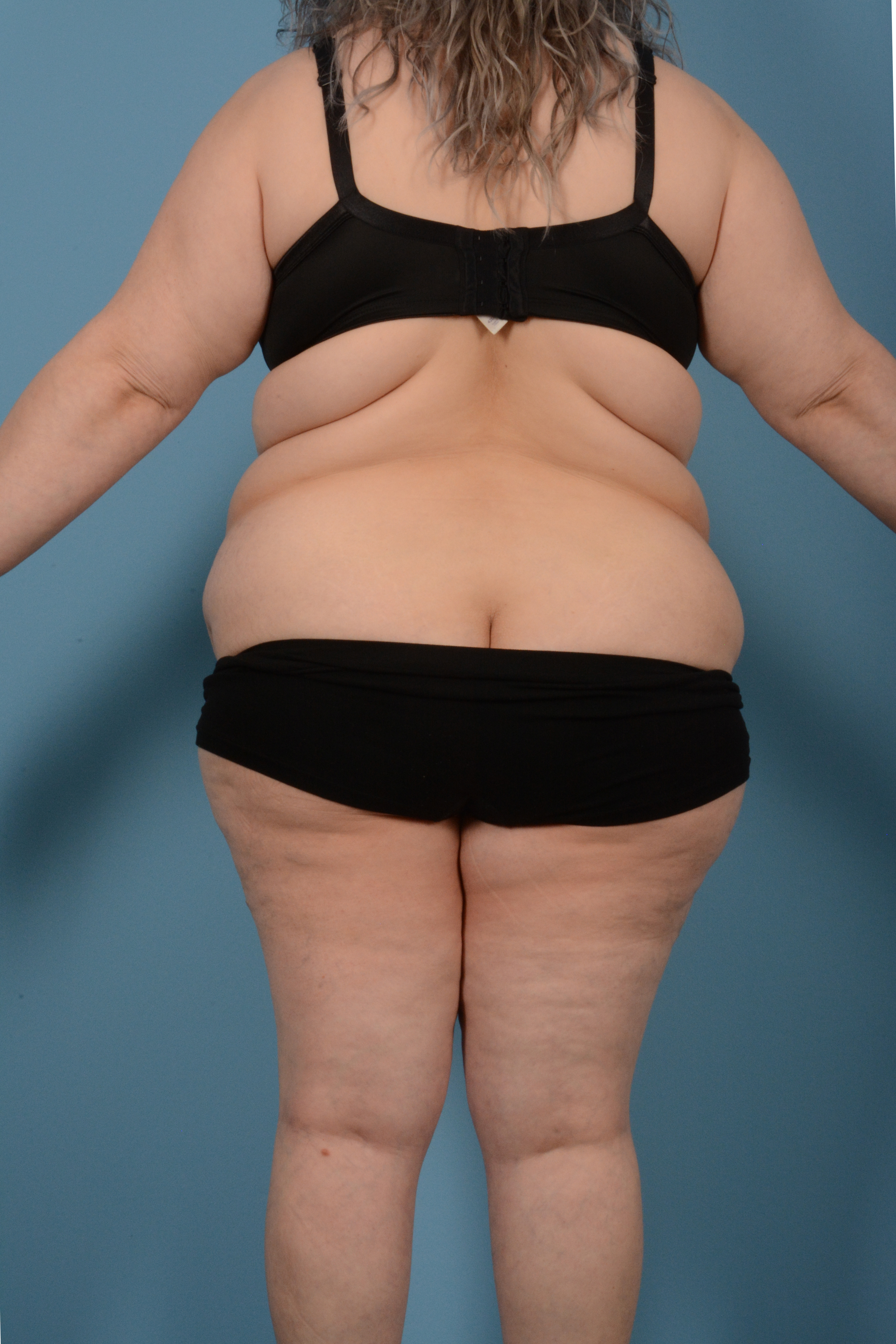 Tummy Tuck (Abdominoplasty)  Before & After Gallery - Patient 146779725 - Image 11