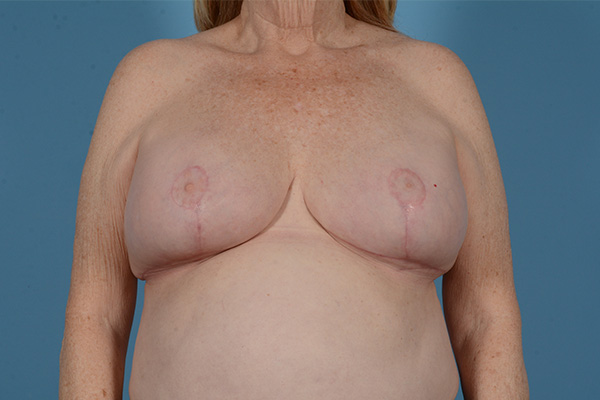 Breast Lift Before & After Gallery - Patient 146779805 - Image 2