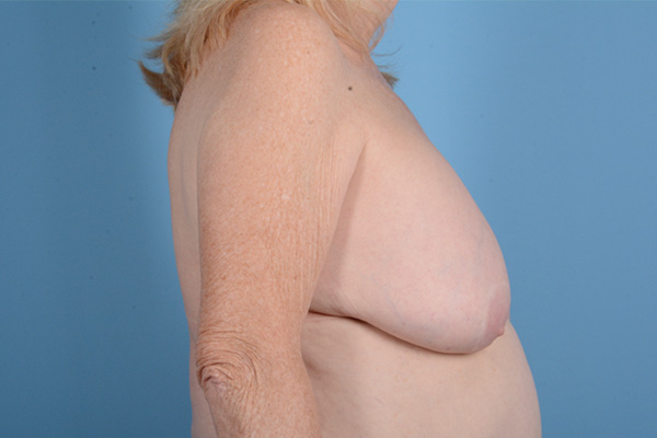 Breast Lift Before & After Gallery - Patient 146779805 - Image 5
